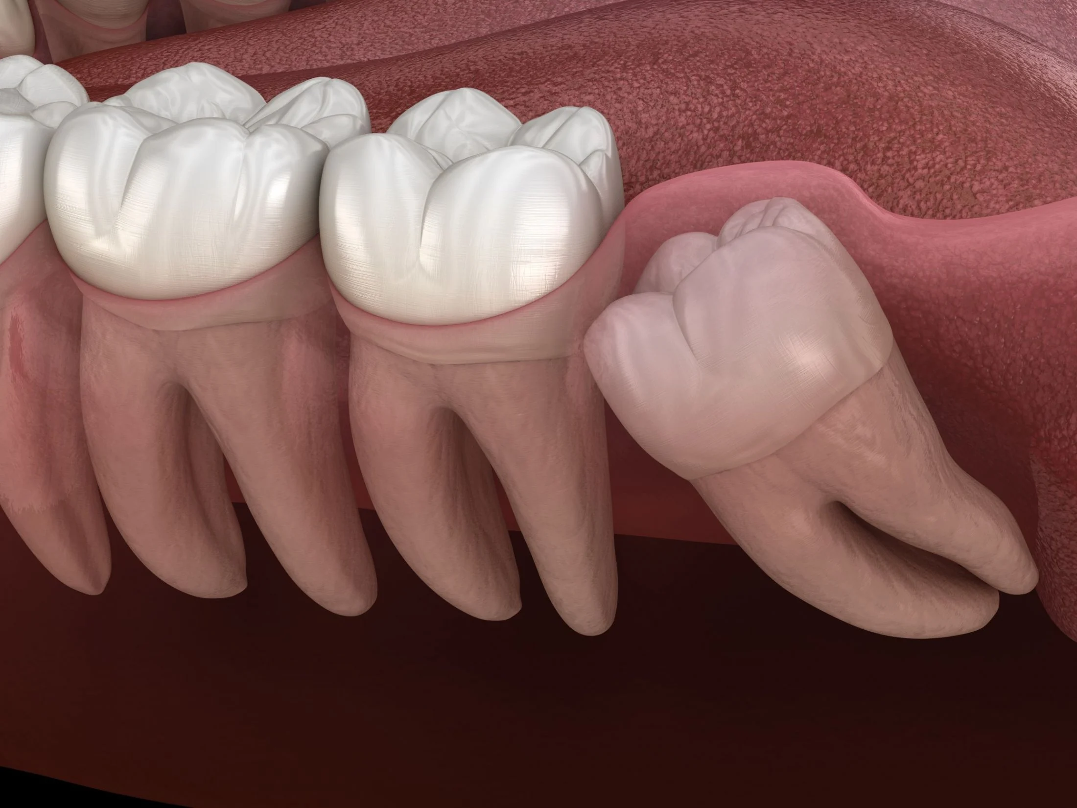 Surgical extractions