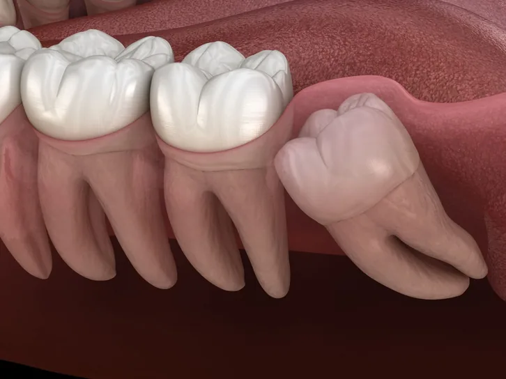 Surgical extractions
