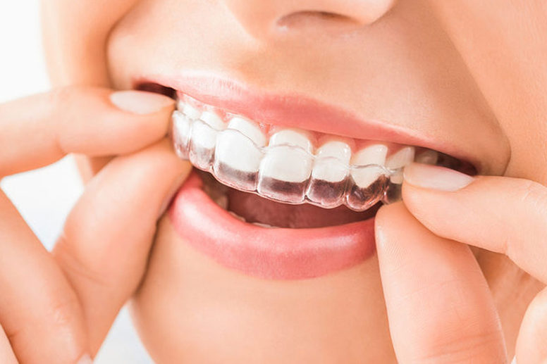 Smile Design