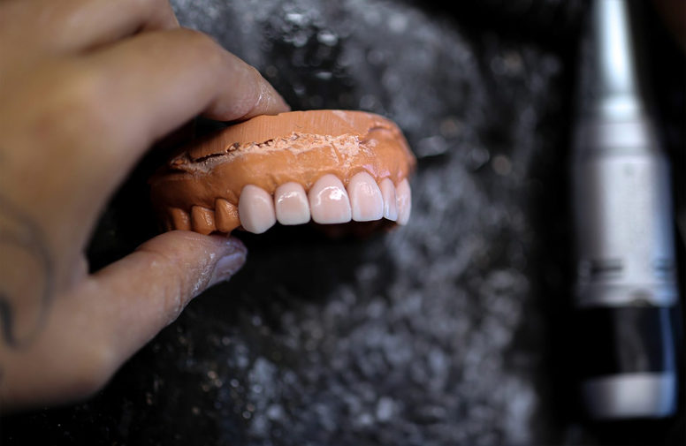 Veneers