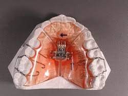 Pediatric dental devices