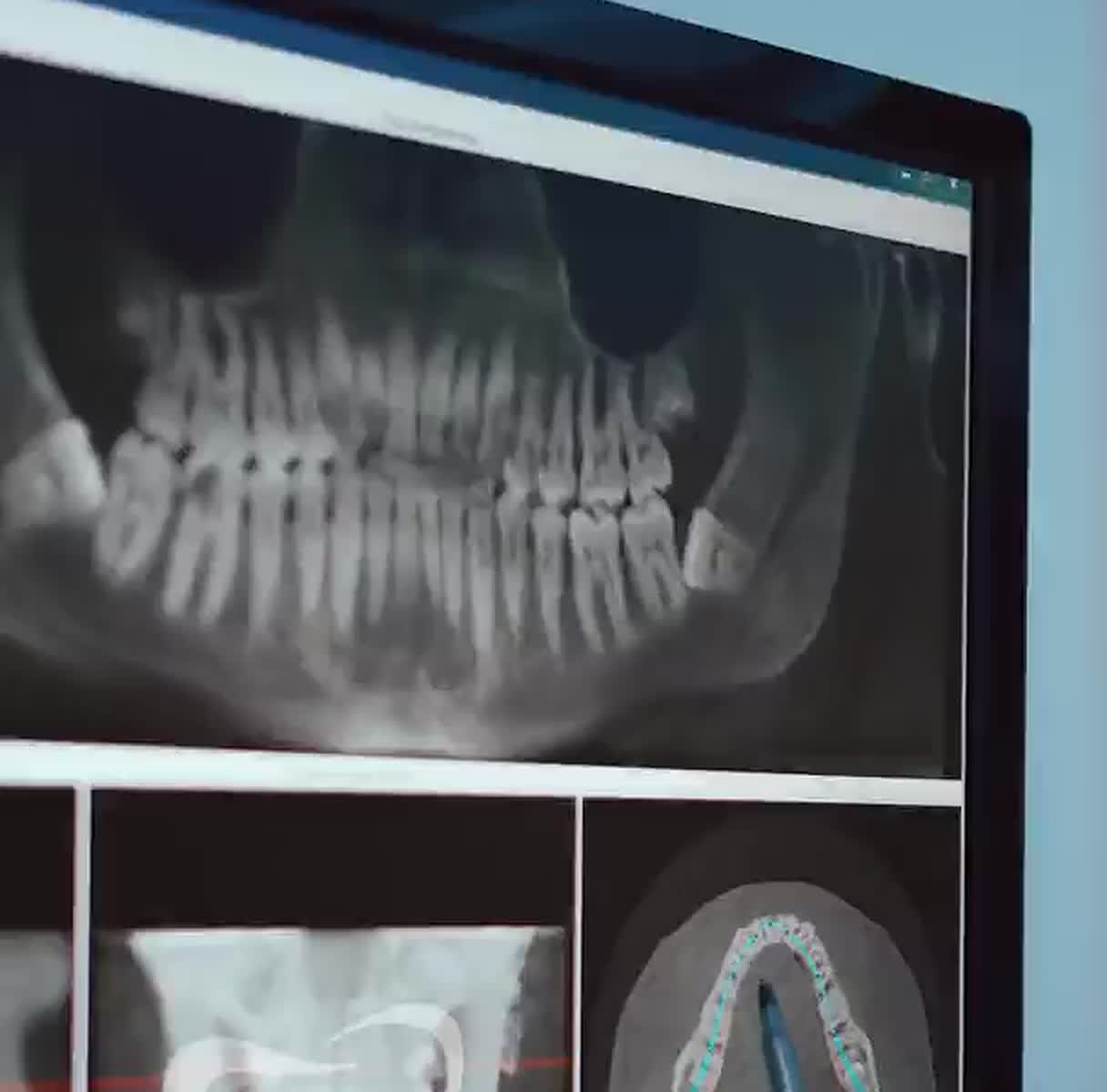 An exploded view of a full-arch case planned in-house: the milled bar above, the implants and abutment screws below it, and the prosthetic teeth seated over the gingiva.