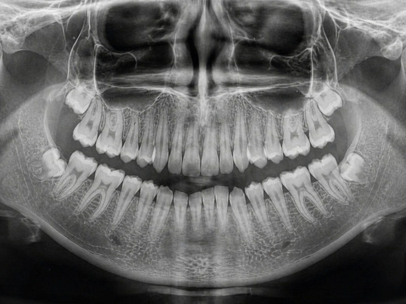 A panoramic radiograph of both arches, showing the roots, the nerve canal and the surrounding bone in one image.